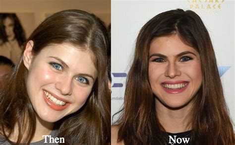 did alexandra daddario get a boob job|Alexandra Daddario Breast Job – Before and After Pictures